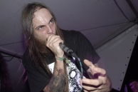 VULVODYNIA